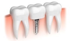 Стоматология АРМ-МЕД ЗДОРОВЬЕ Зубные импланты