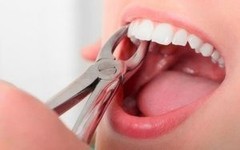 Стоматология АРМ-МЕД ЗДОРОВЬЕ Удаление зубов